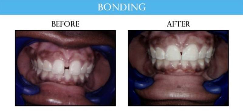 before and after smile gallery image