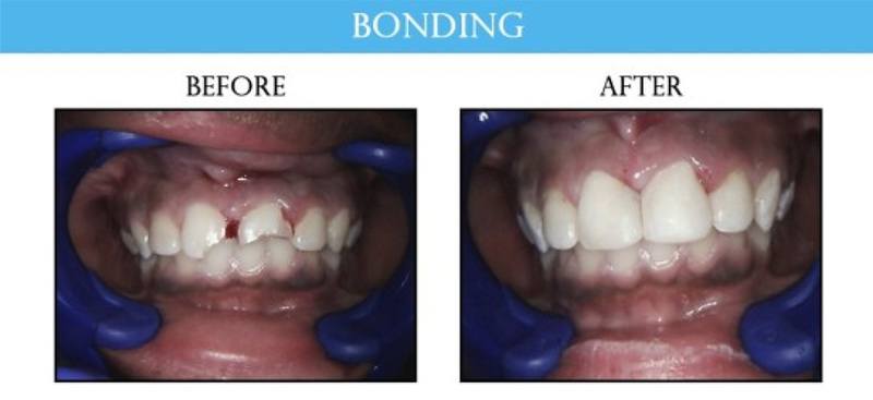 before and after smile gallery image