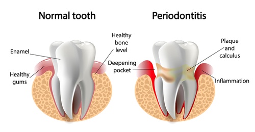 periodontitis in Fords, NJ