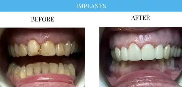 Before and after dental implants